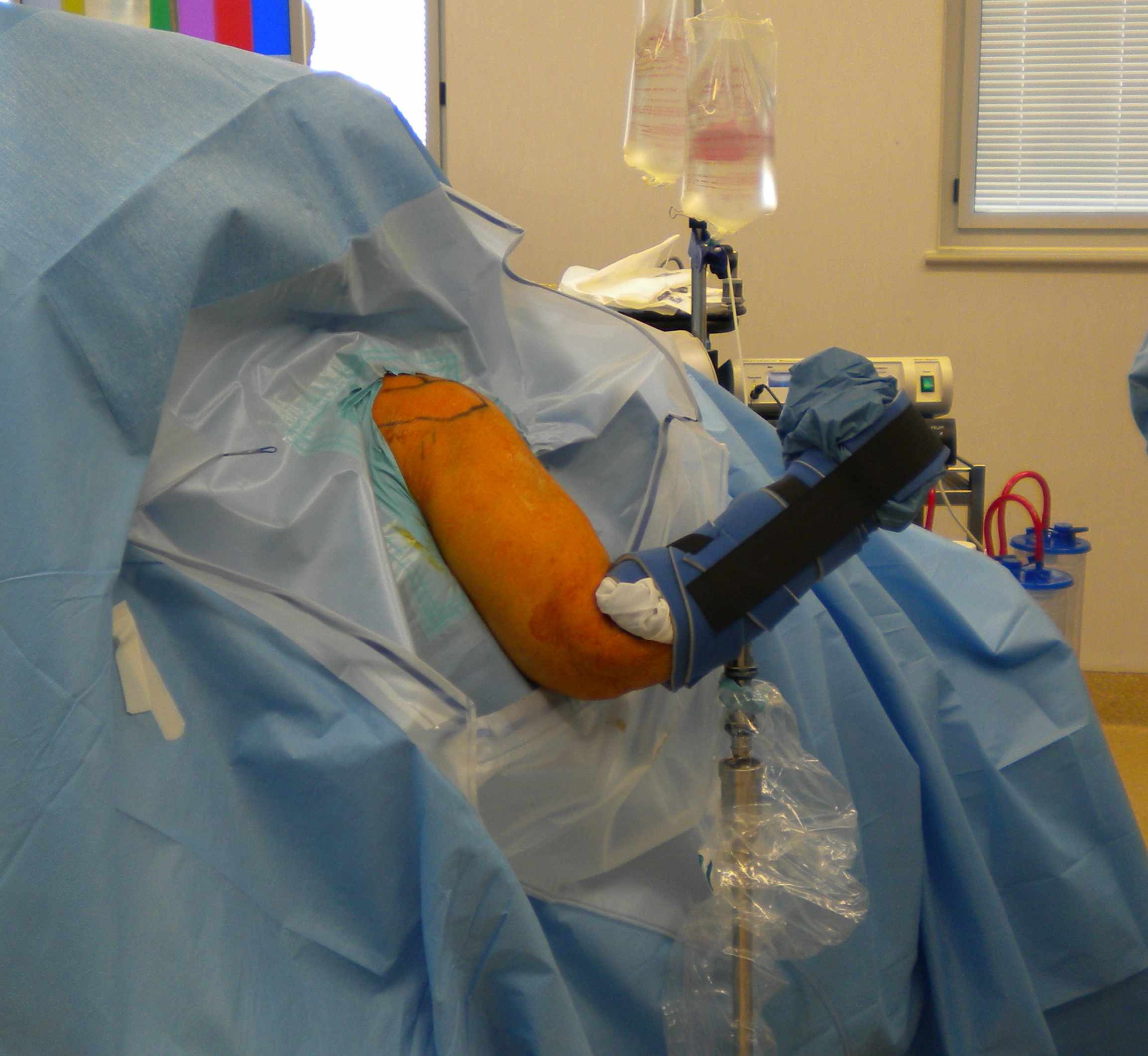 Shoulder Arthroscopy Spyder